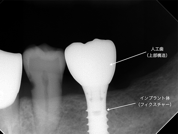 人工歯とインプラント